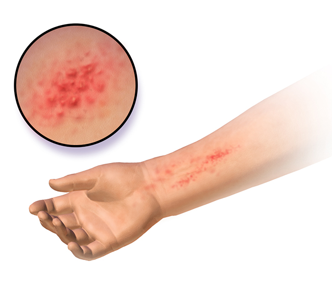 What is Allergic Dermatitis?