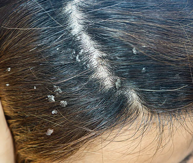 What is Dandruff?