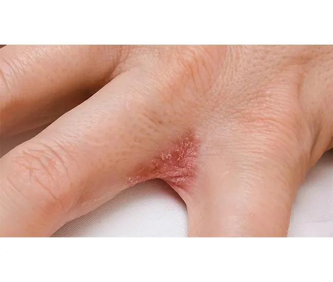 Causes & Triggers of Eczema