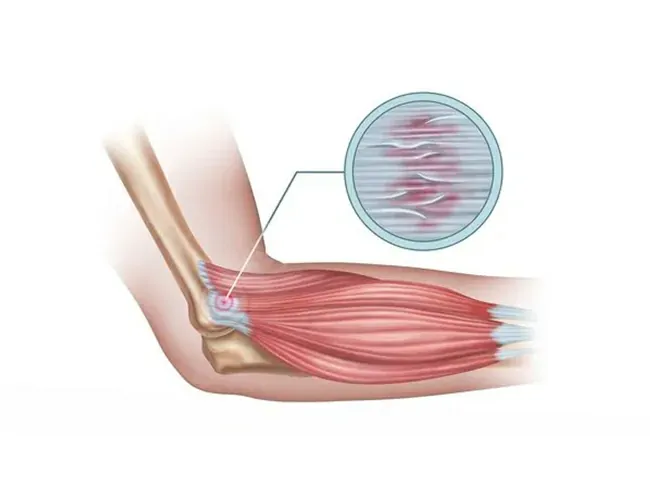 Symptoms of Tennis Elbow