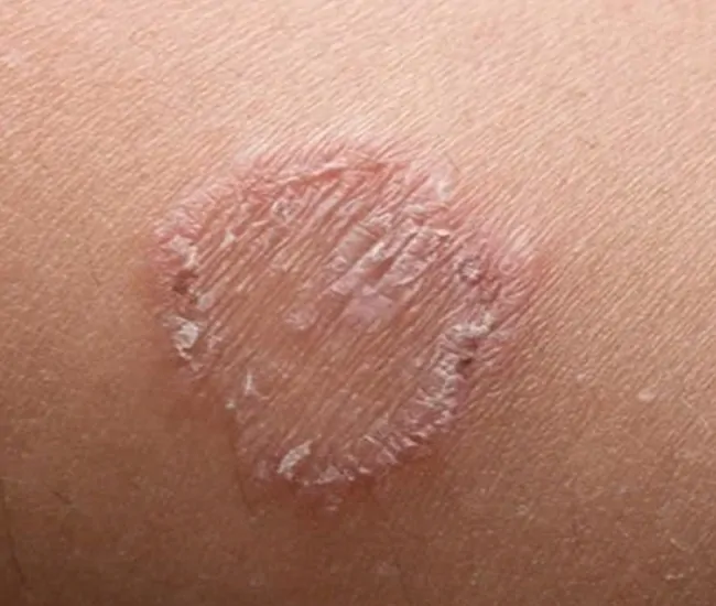 Symptoms of Fungal Infection & Jock Itch