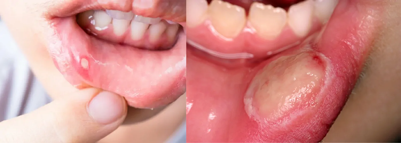 Mouth Ulcers – Causes, Types, Treatment & Diet