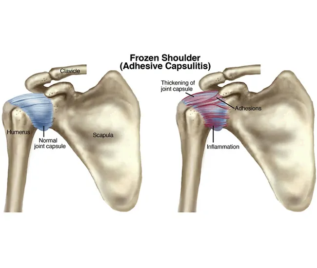 Symptoms of Frozen Shoulder & Periarthritis