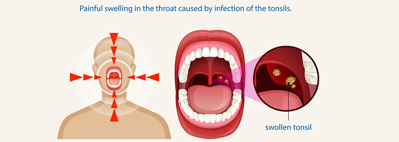 Tonsillitis & Adenoid Hypertrophy – Causes, Symptoms & Holistic Treatments