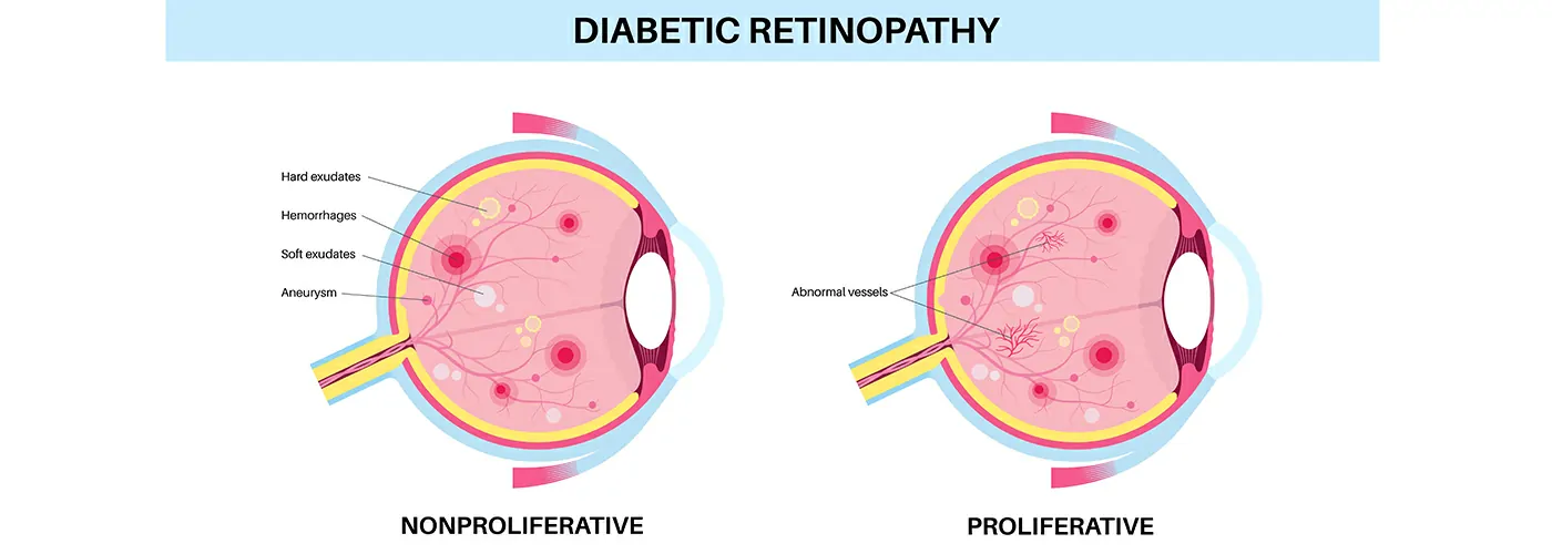 Diabetic Retinopathy – Causes, Symptoms & Holistic Treatments