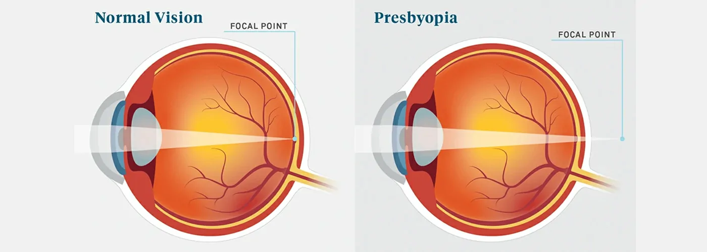Presbyopia and Myopia – An Ayurvedic Perspective