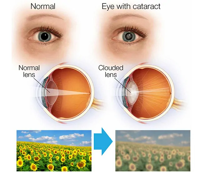 What is Cataract?