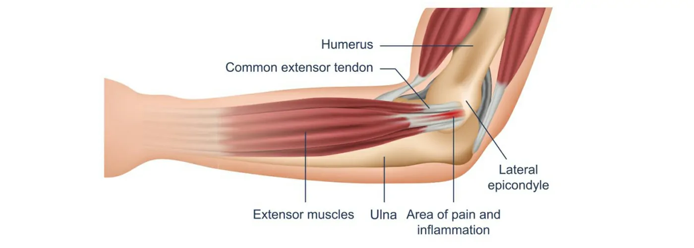 Tennis Elbow (Lateral Epicondylitis) – Ayurveda, Siddha, Homeopathy & Physiotherapy Treatment