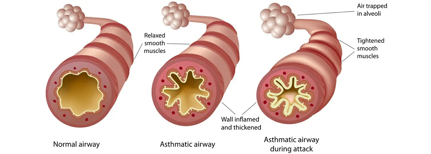 Asthma & Bronchitis – Causes, Symptoms & Holistic Treatments