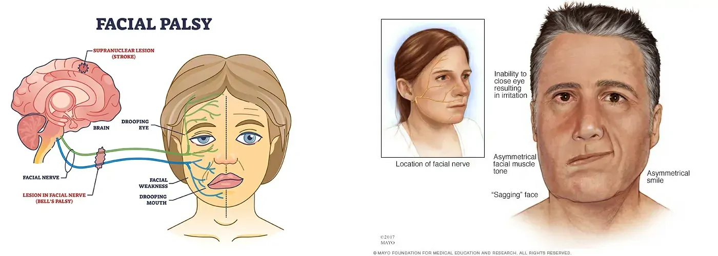 Bell’s Palsy: Holistic Healing with Ayurveda, Siddha & Homeopathy