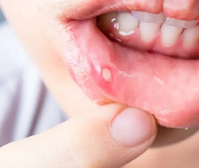 Causes of Mouth Ulcers