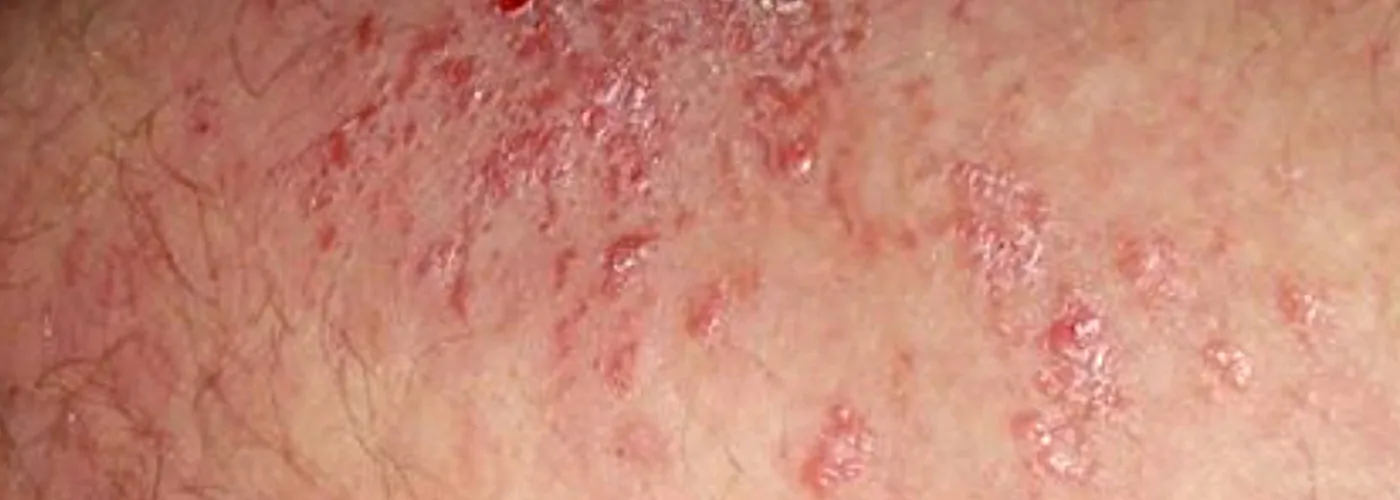 Fungal Infection & Jock Itch – Causes, Symptoms & Natural Healing with Ayurveda, Siddha & Homeopathy