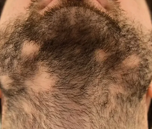 Causes of Alopecia Areata in Males