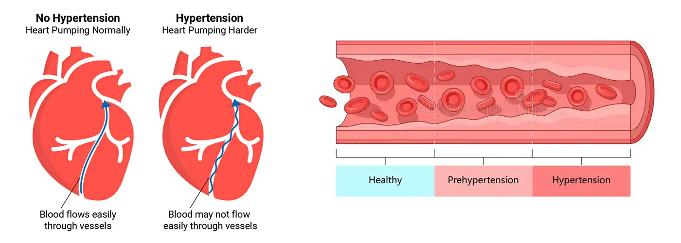 Hypertension (HTN) & Blood Pressure (BP): Causes, Types, and Holistic Treatments