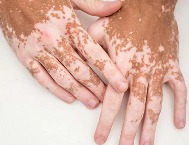 Causes of Vitiligo