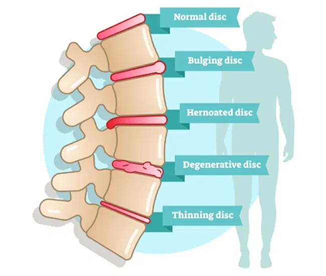 Symptoms of Disc Bulge & Nerve Compression