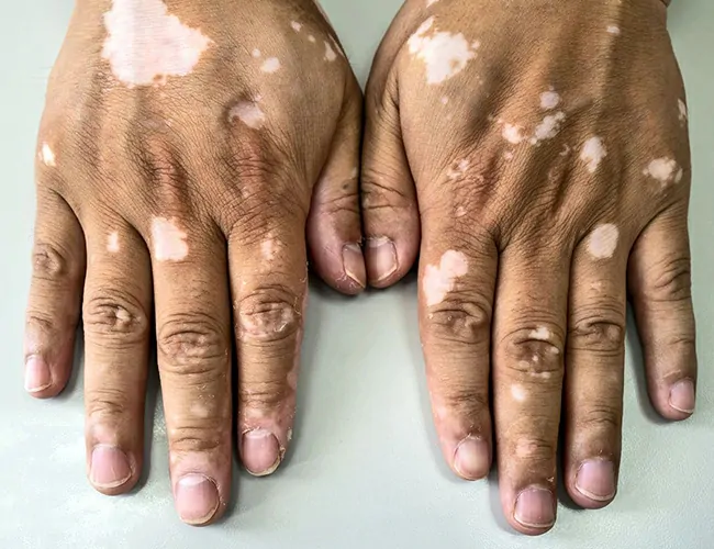 Symptoms of Vitiligo