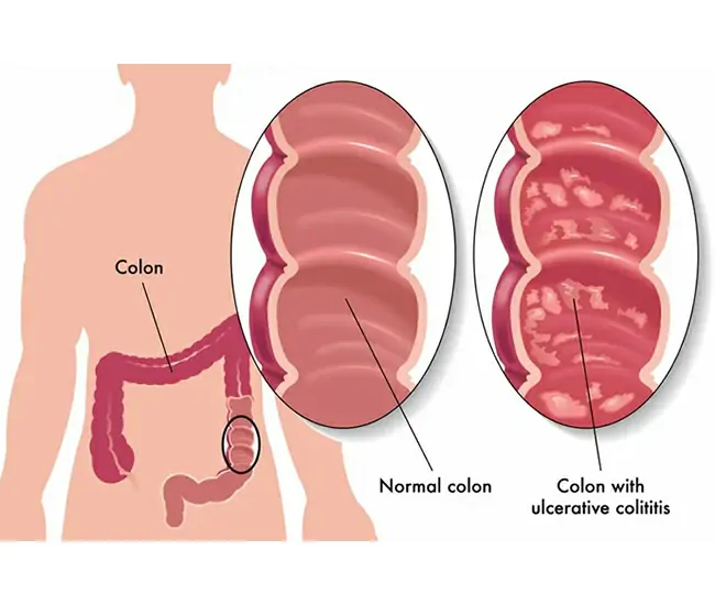 What are Peptic Ulcer, Ulcerative Colitis & Duodenal Ulcer?