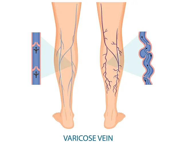 Types of Varicose Veins