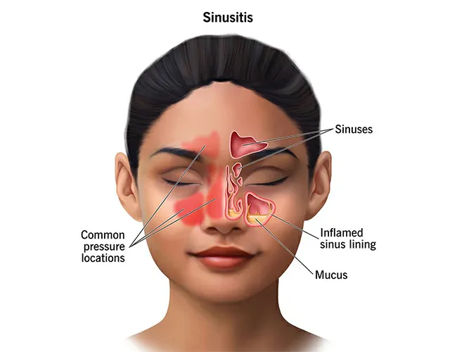 Causes of Sinusitis & Allergic Rhinitis