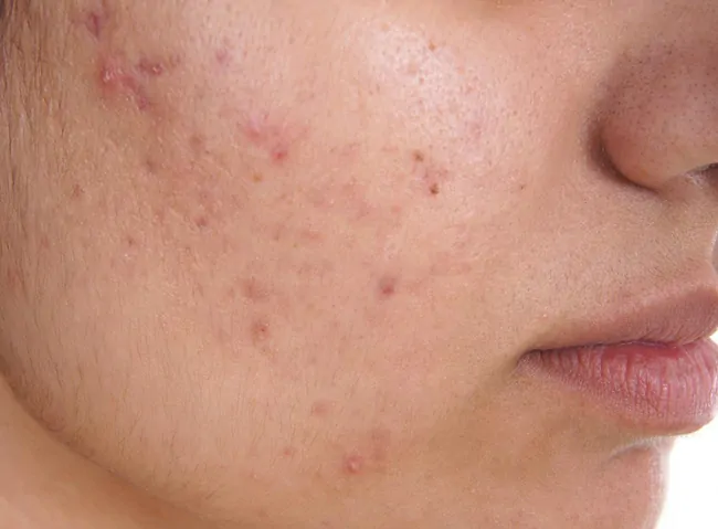What is Acne?