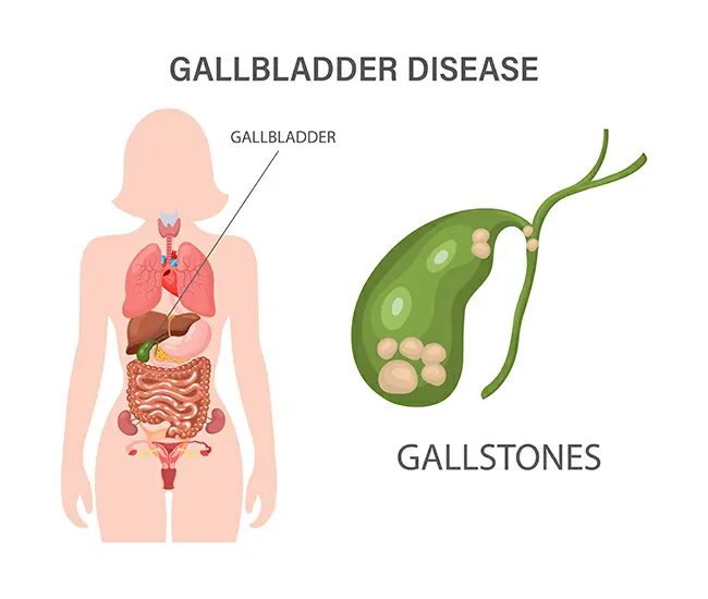 Causes of Gallstones