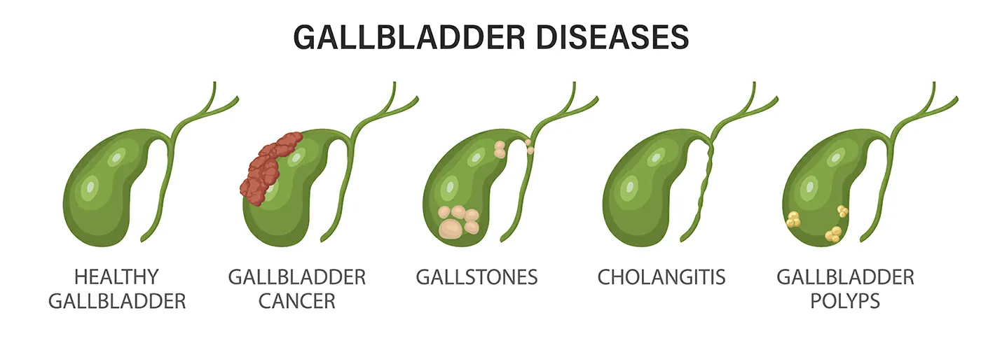 Cholelithiasis (Gallstones) – Causes, Symptoms, Treatment & Diet