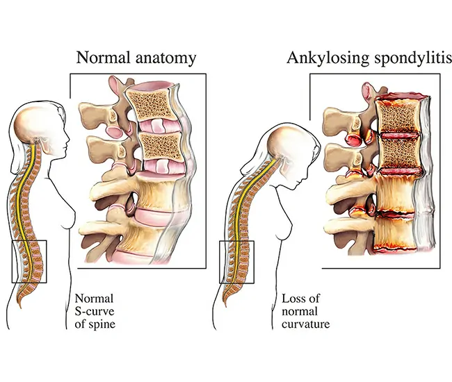 Causes of Ankylosing Spondylosis
