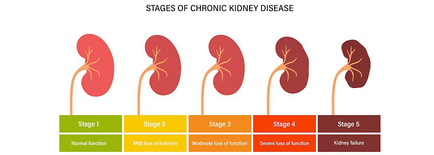 Kidney Stones & Kidney Disease: Causes, Symptoms, and Natural Remedies
