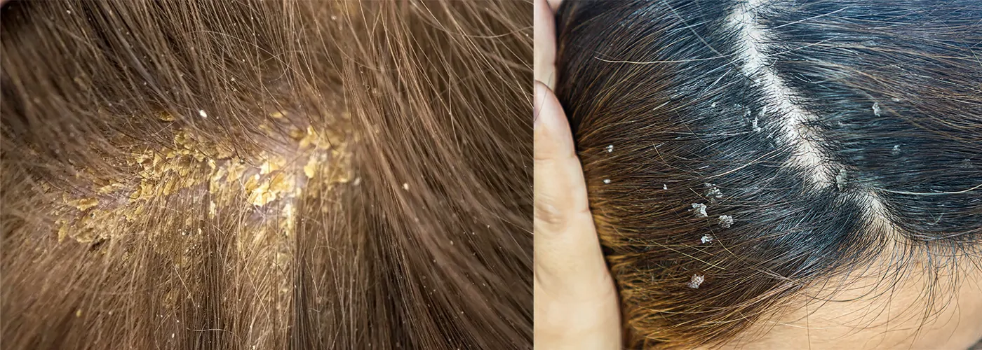 Dandruff & Folliculitis – Ayurvedic, Siddha & Homeopathic Solutions