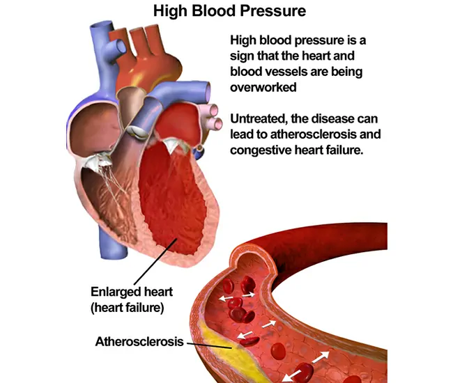 What is Hypertension (High Blood Pressure)?
