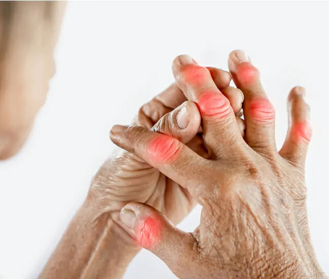 What is Rheumatoid Arthritis (RA)?