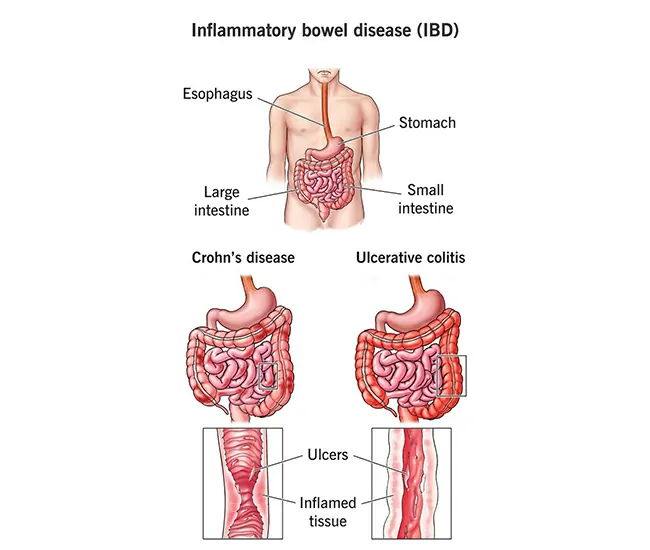 Causes of IBS & IBD