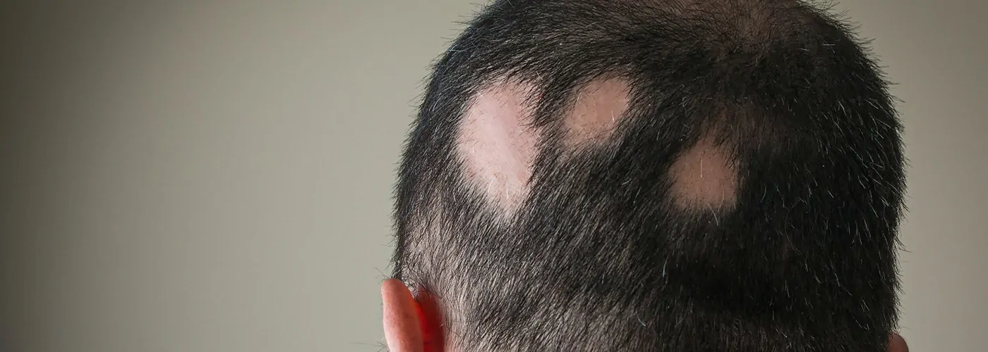 Alopecia Areata in Males – Causes, Symptoms & Holistic Treatments