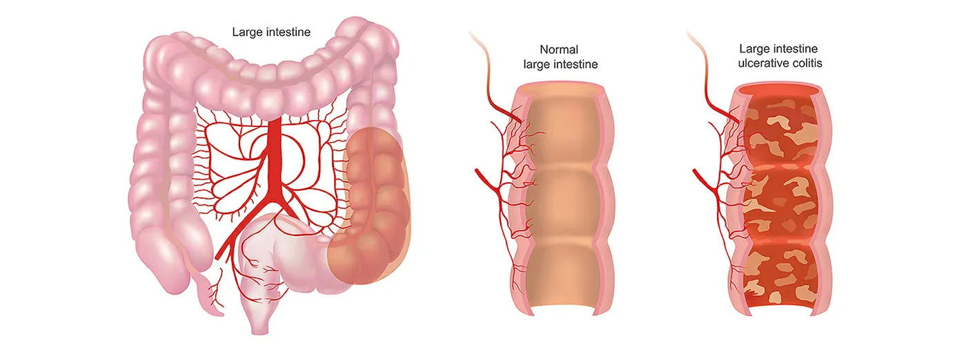 Peptic Ulcer, Ulcerative Colitis & Duodenal Ulcer – Causes, Symptoms & Treatment