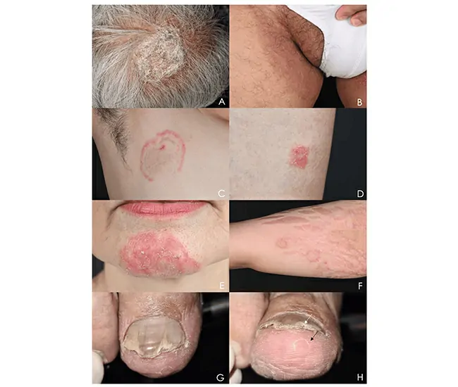 What is Fungal Infection & Jock Itch?