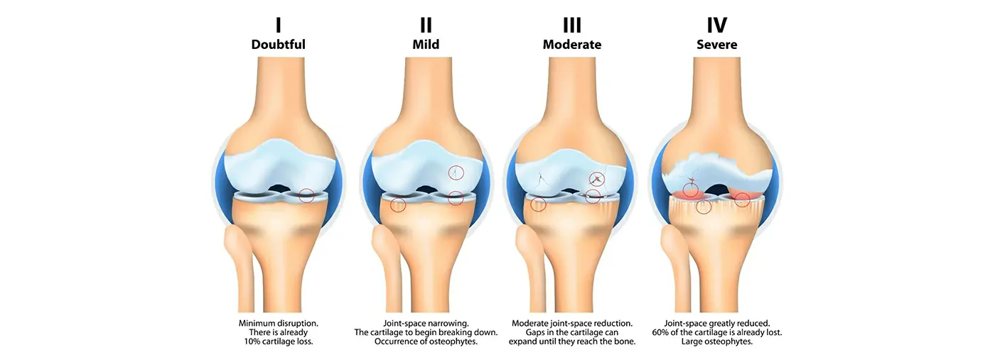 Knee Osteoarthritis (OA) – Ayurveda, Siddha, Homeopathy & Physiotherapy Treatment