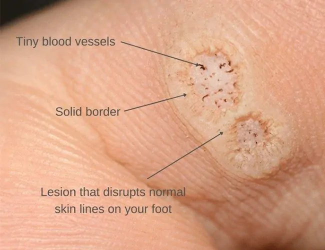 Symptoms of Warts & Corn Foot