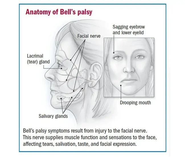 Causes of Bell’s Palsy