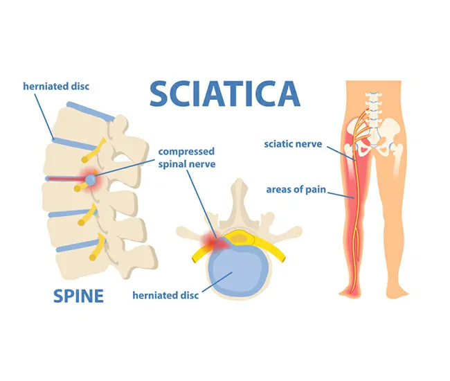 Symptoms of Sciatica