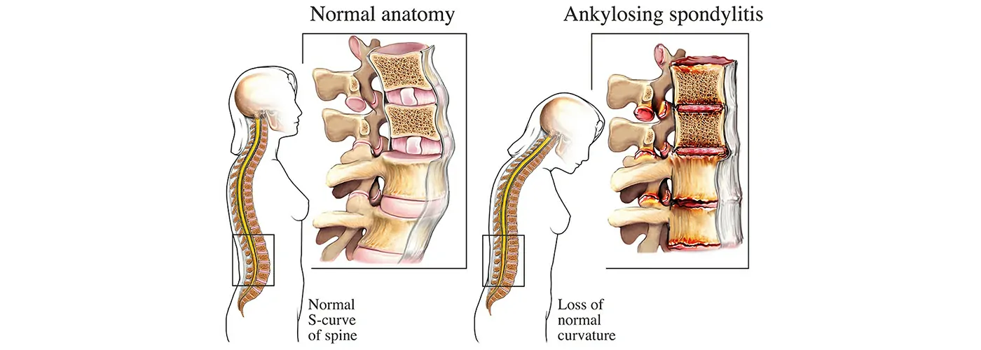 Ankylosing Spondylosis – Ayurveda, Siddha, Homeopathy & Physiotherapy Treatment