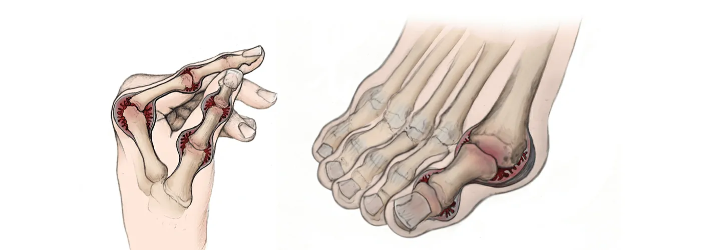 Rheumatoid Arthritis (RA): Causes, Symptoms & Natural Treatments
