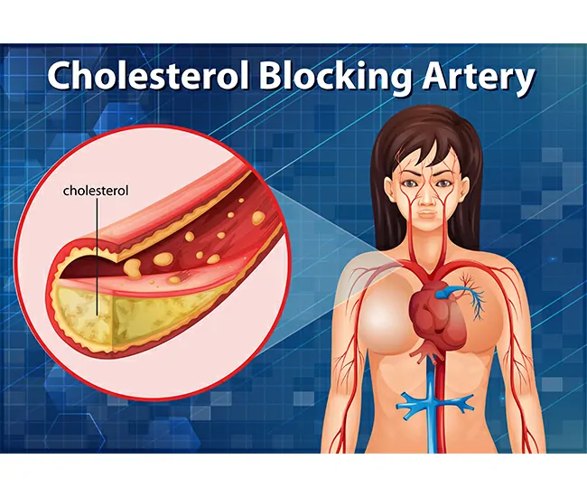 What is Hypercholesterolemia?