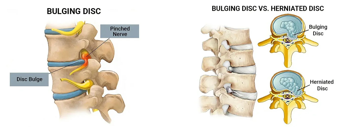 Disc Bulge & Spine Health: Causes, Symptoms & Holistic Treatments