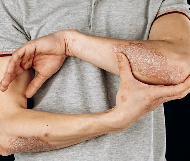 Causes & Triggers of Psoriasis