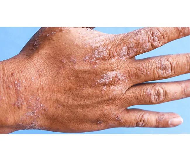 Symptoms of Eczema