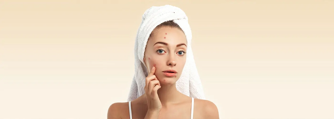 Acne – Causes, Types & Natural Healing with Ayurveda, Siddha & Homeopathy