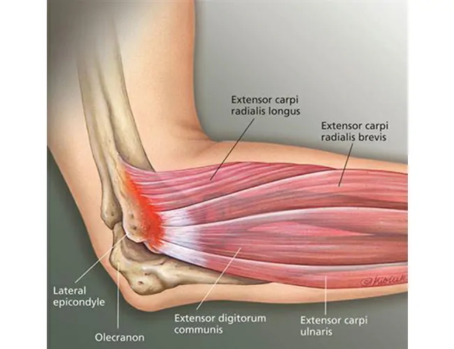 What is Tennis Elbow?