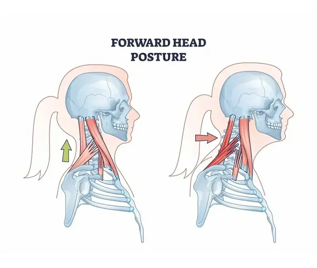 What is Cervical Spondylosis?
