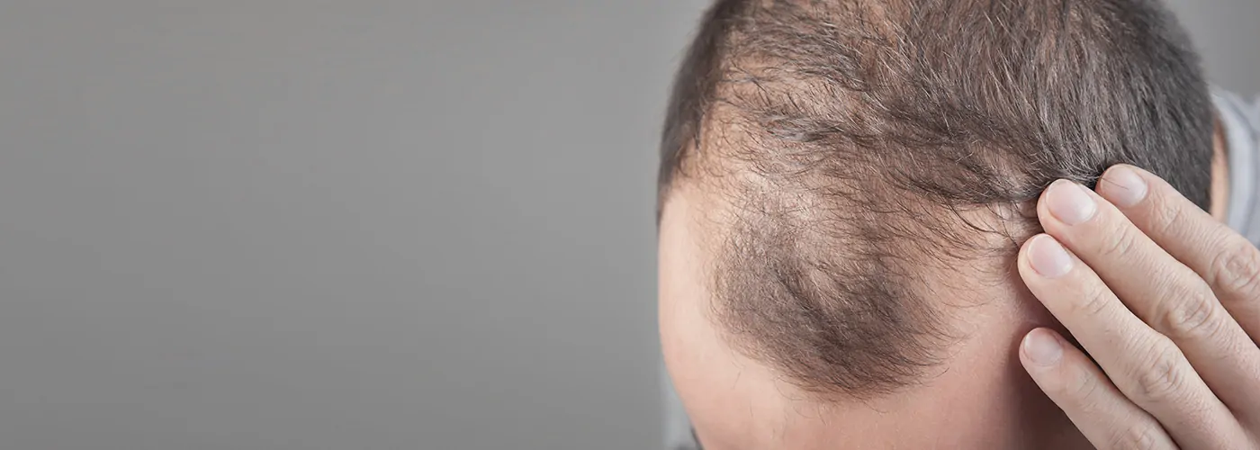 Male Pattern Hair Fall & Baldness – Causes, Stages & Holistic Treatments